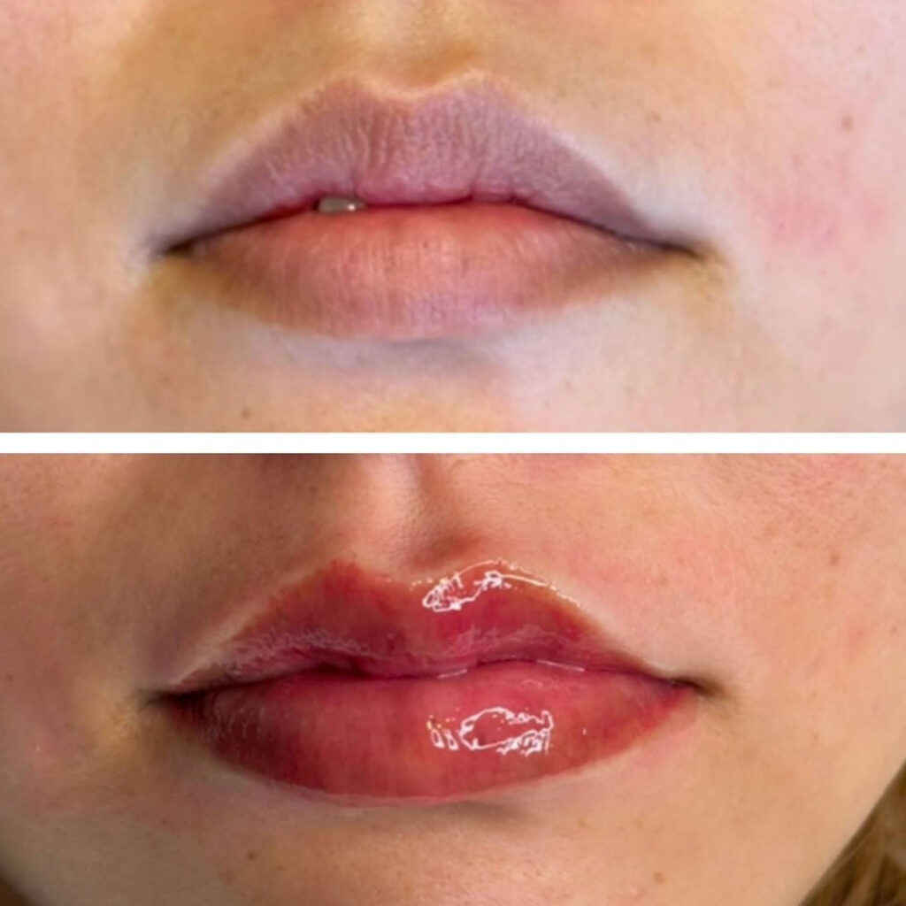 唇のアートメイクの症例