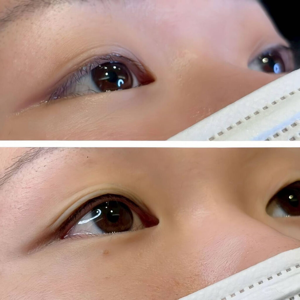 アイラインのアートメイクの症例