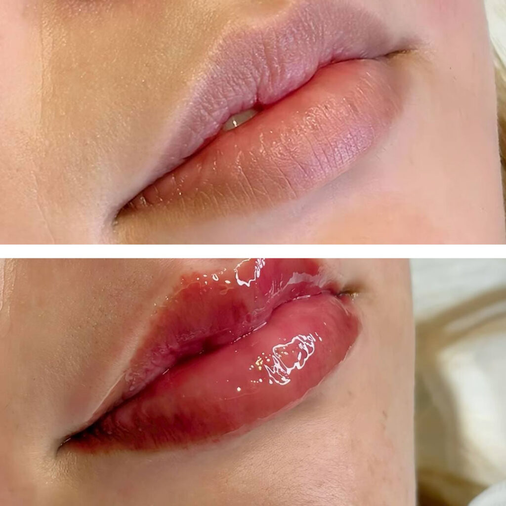 唇のアートメイクを受けた女性の症例写真