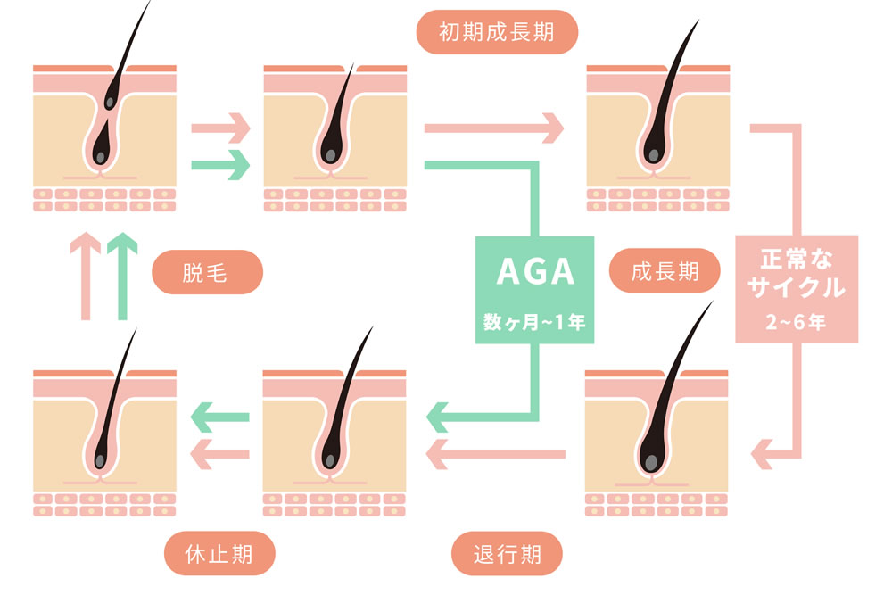 AGAのヘアサイクル