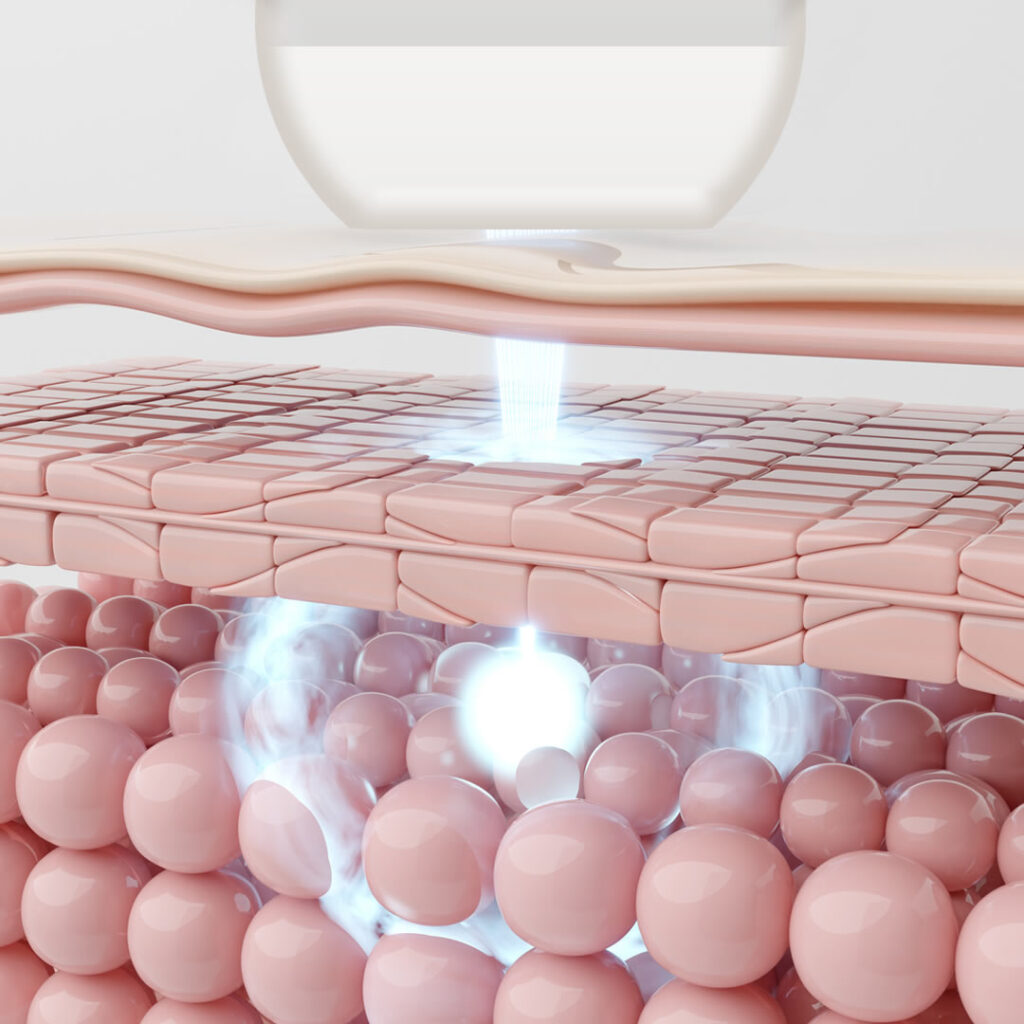 LDMの超音波の図解