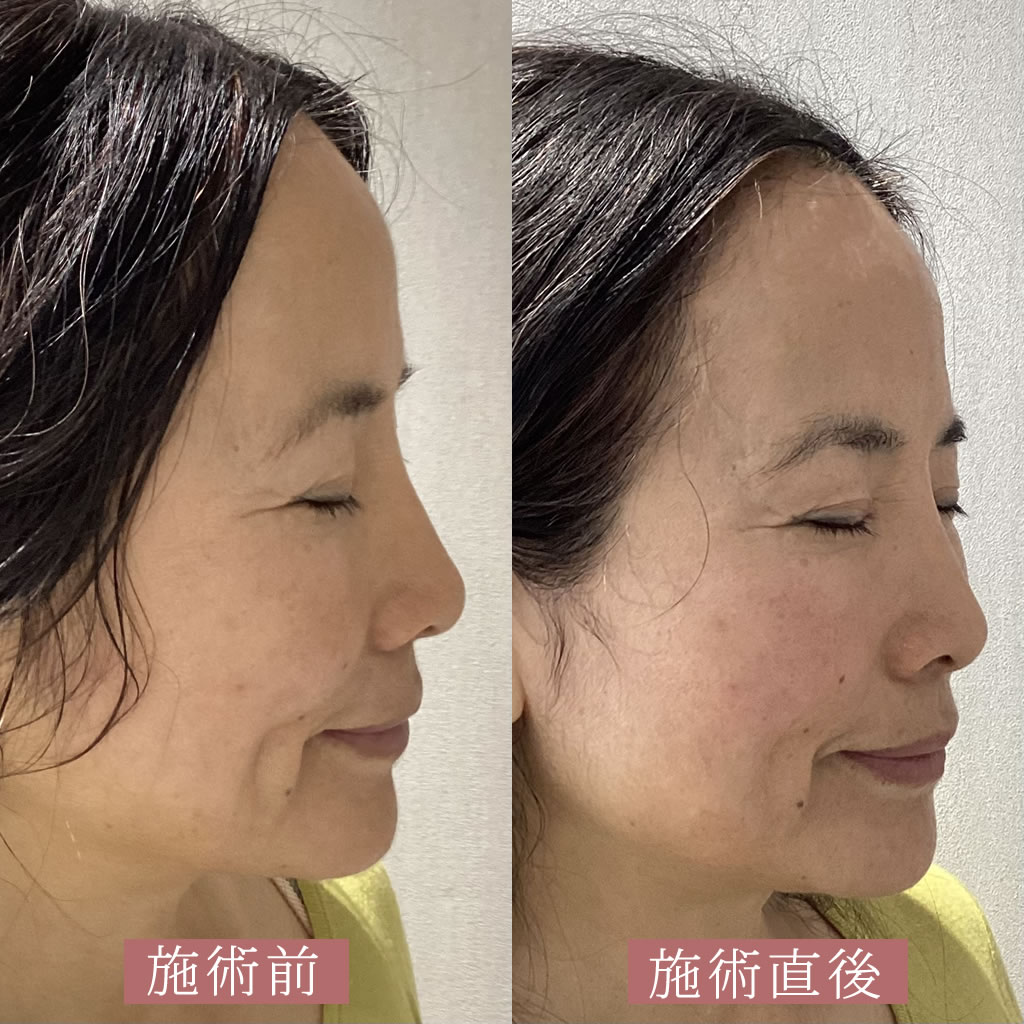 HIFU+ケアシスの右向きの症例写真