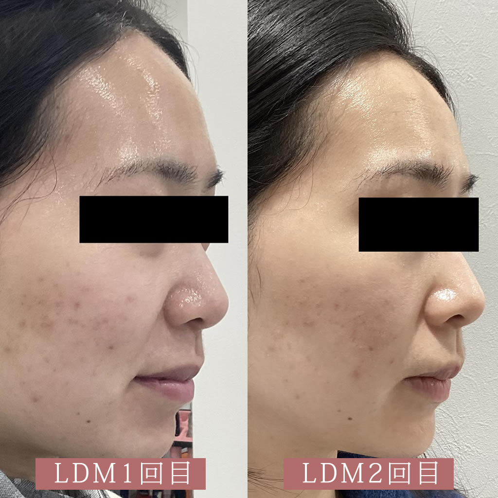 LDMの症例写真5