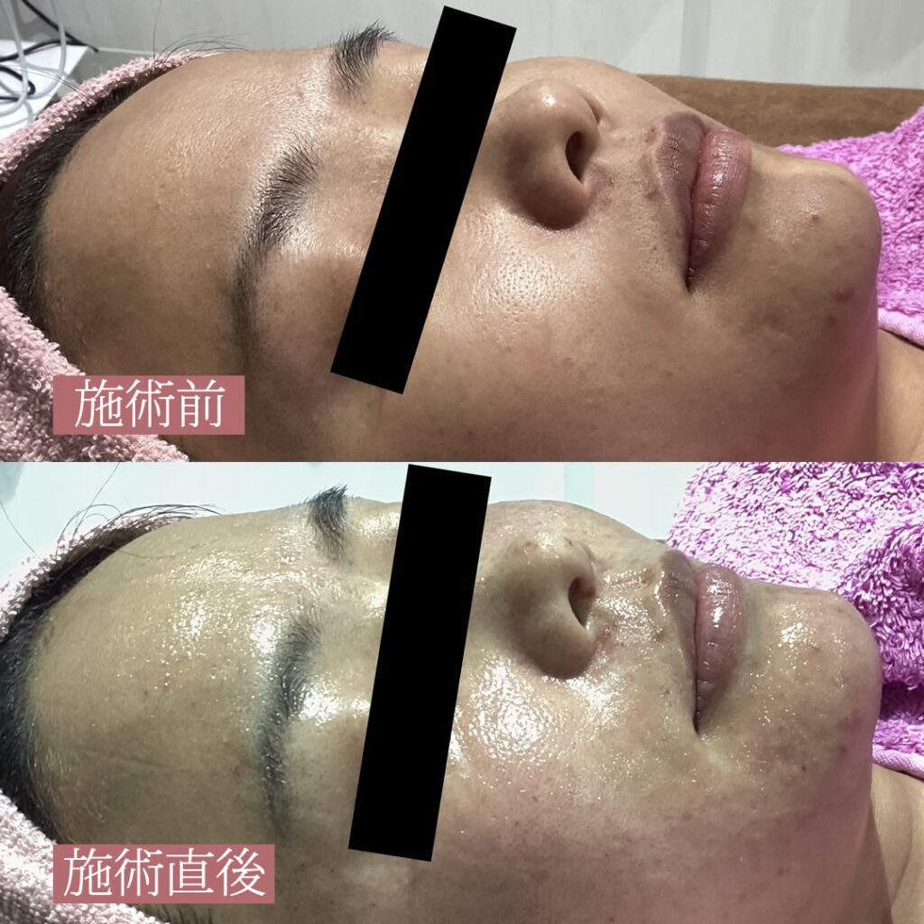 水光注射の横向きの症例写真