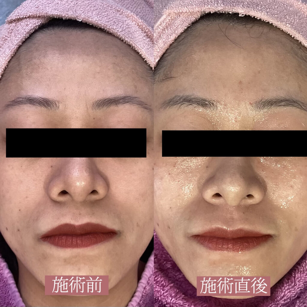 水光注射の１回目の症例写真