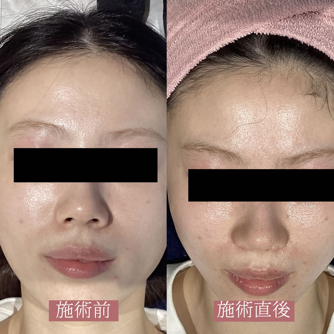 LDMの２回目の症例写真