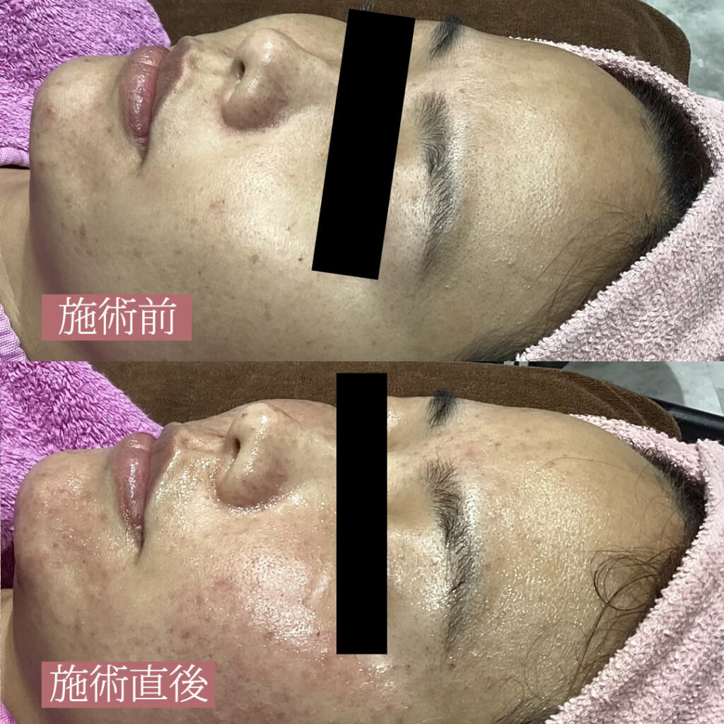 水光注射の症例写真