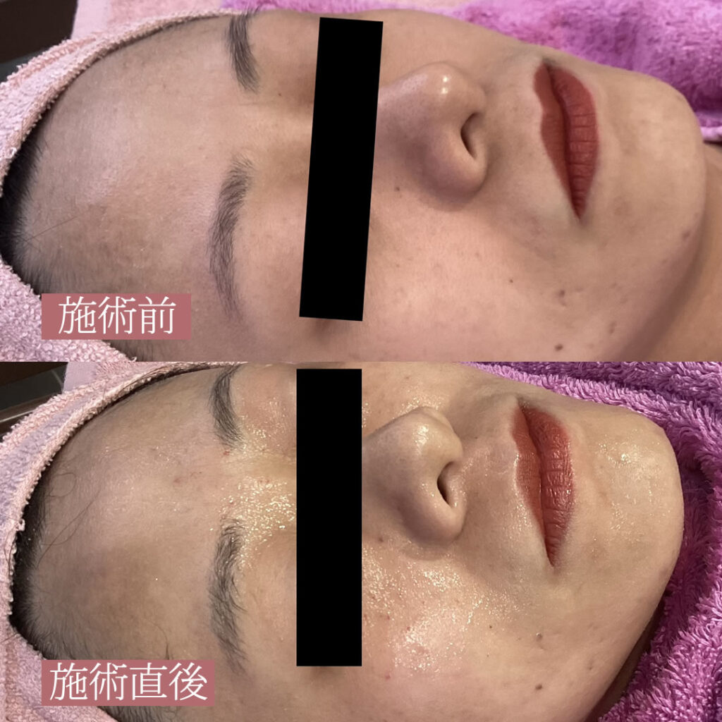 水光注射の１回目の横向きの症例写真