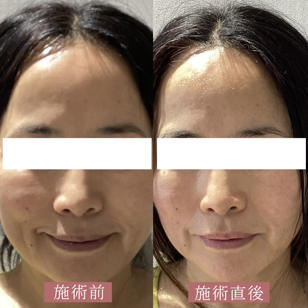 HIFU+ケアシスの正面の症例写真　