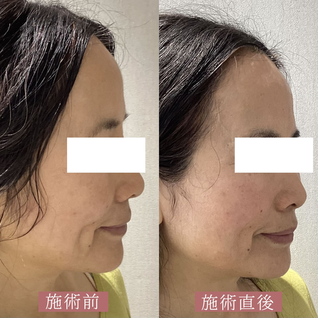 HIFU+ケアシスの正面の症例写真　