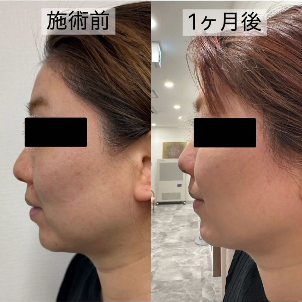 ハイフの症例写真