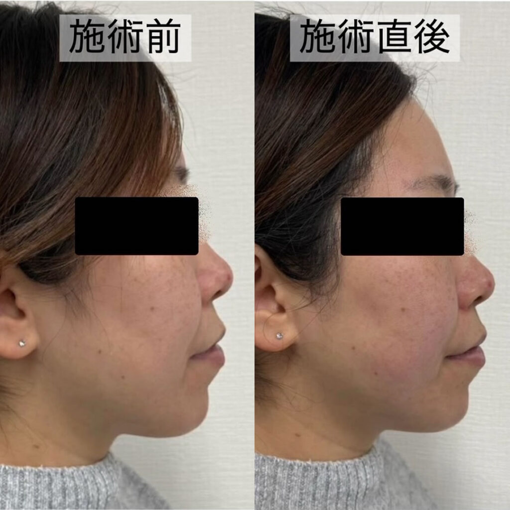 ハイフの症例写真