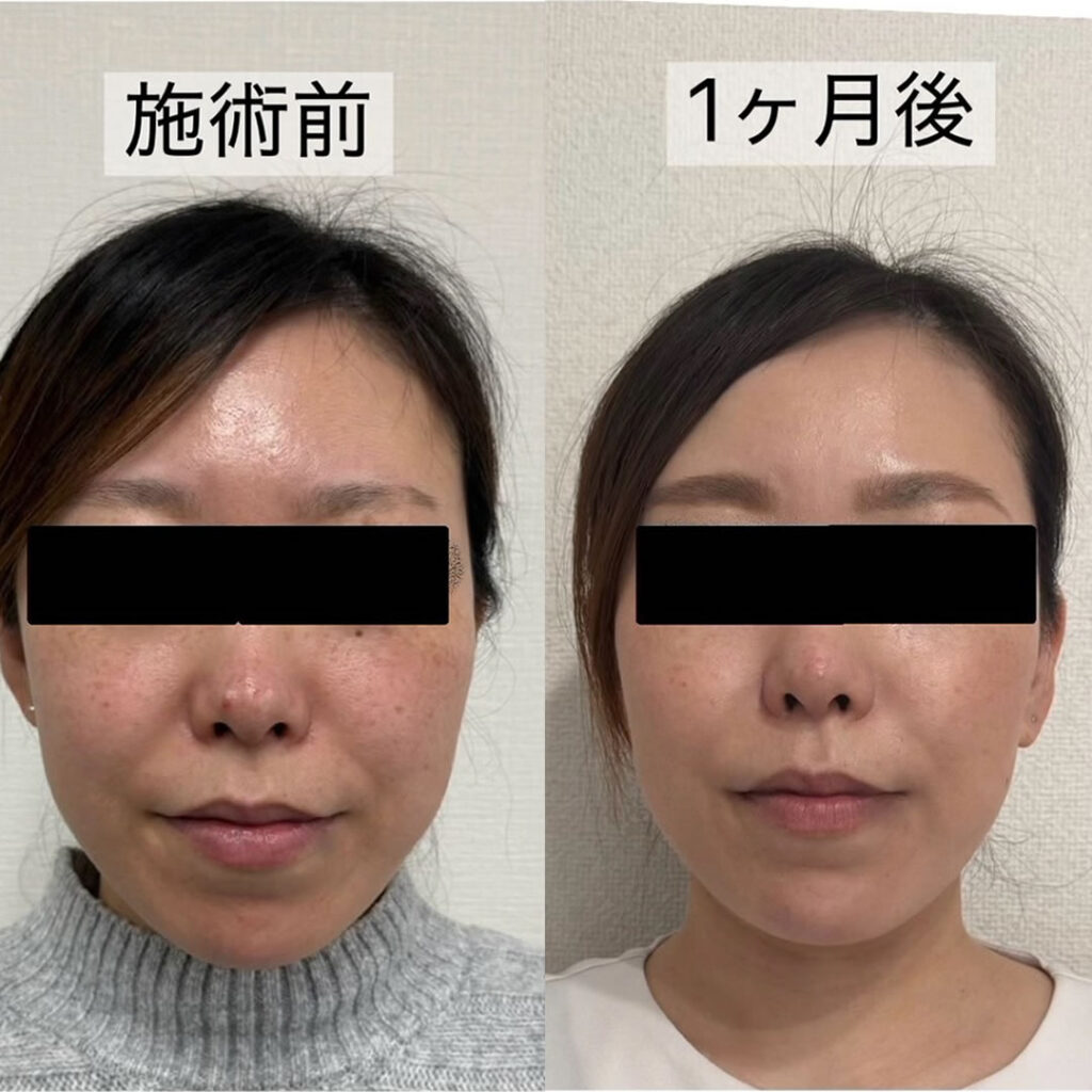 ハイフの症例写真