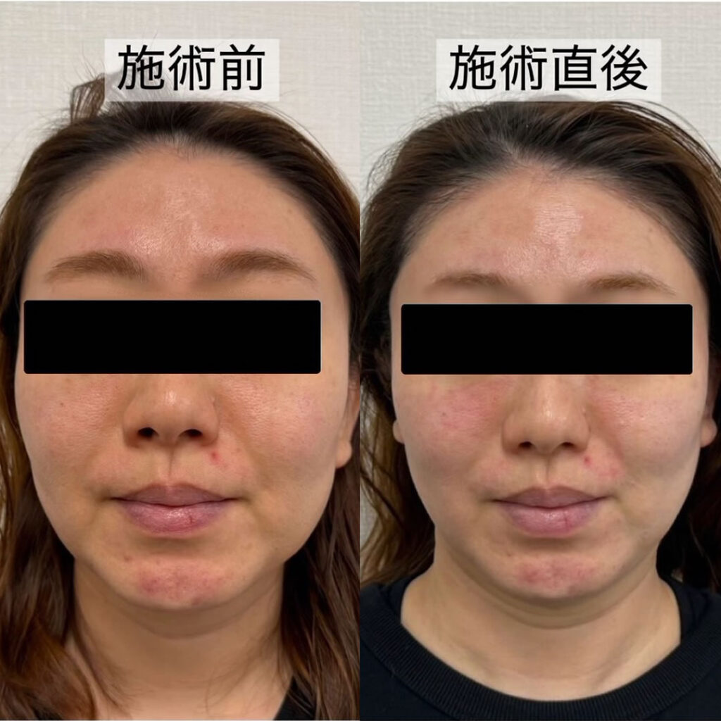 ハイフの症例写真