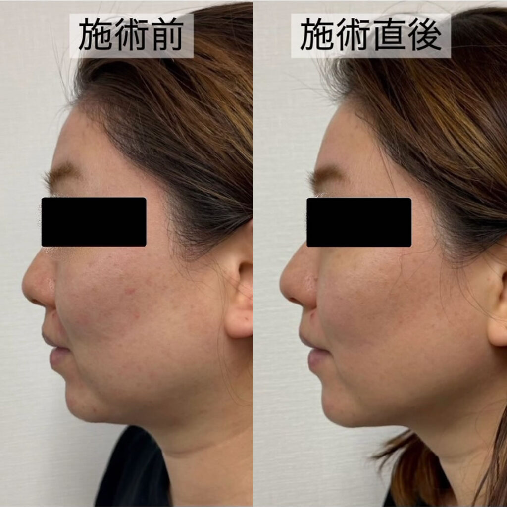 ハイフの症例写真