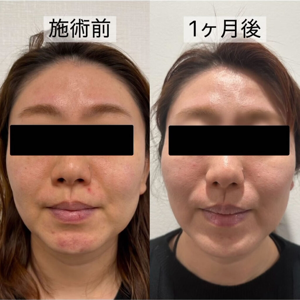 ハイフの症例写真