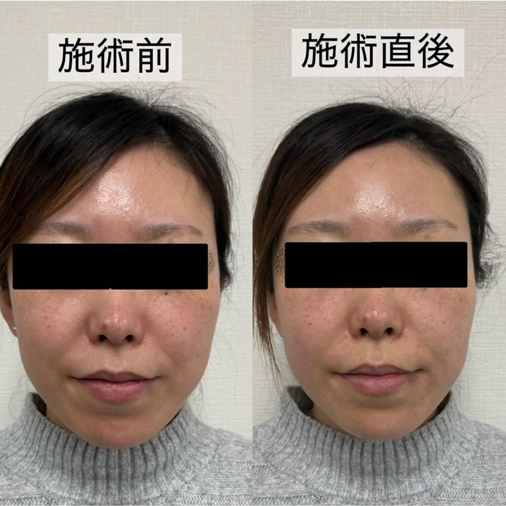 ハイフの症例写真