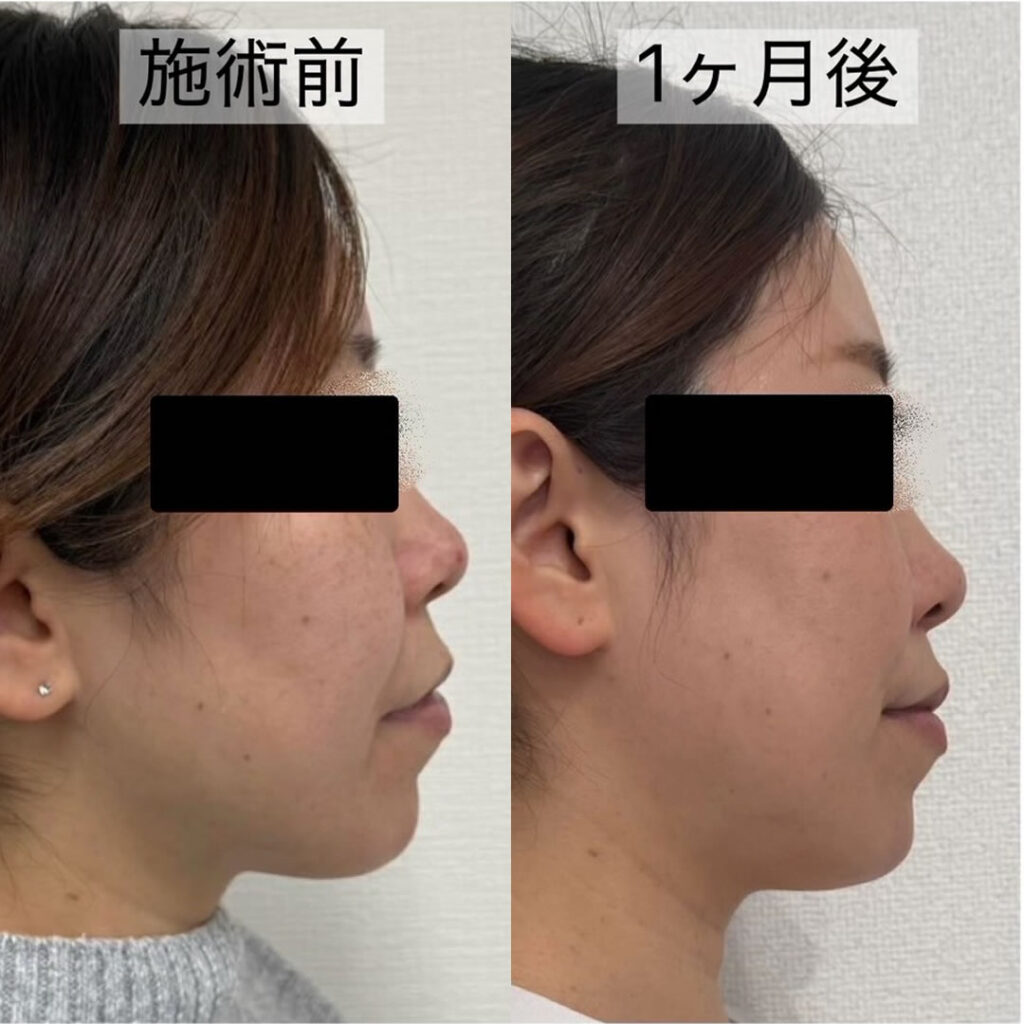 ハイフの症例写真